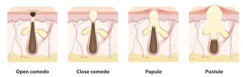 blackheads and whiteheads