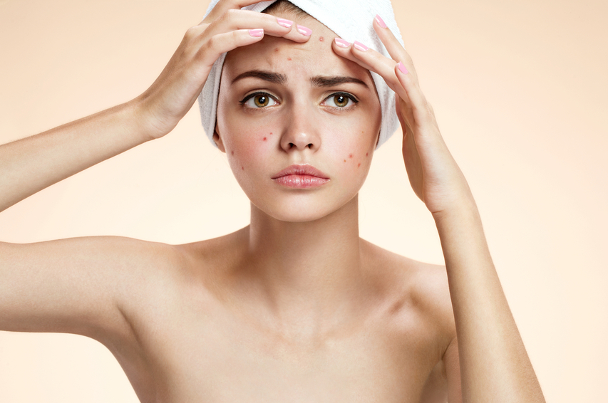 Woman trying to get rid of acne pimples