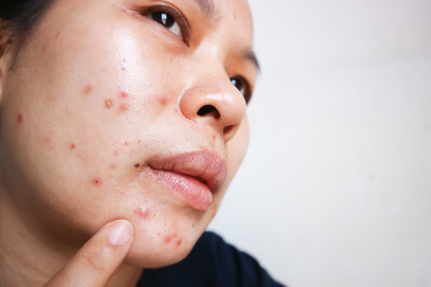 Woman struggling with acne breakouts and pimples on her cheeks
