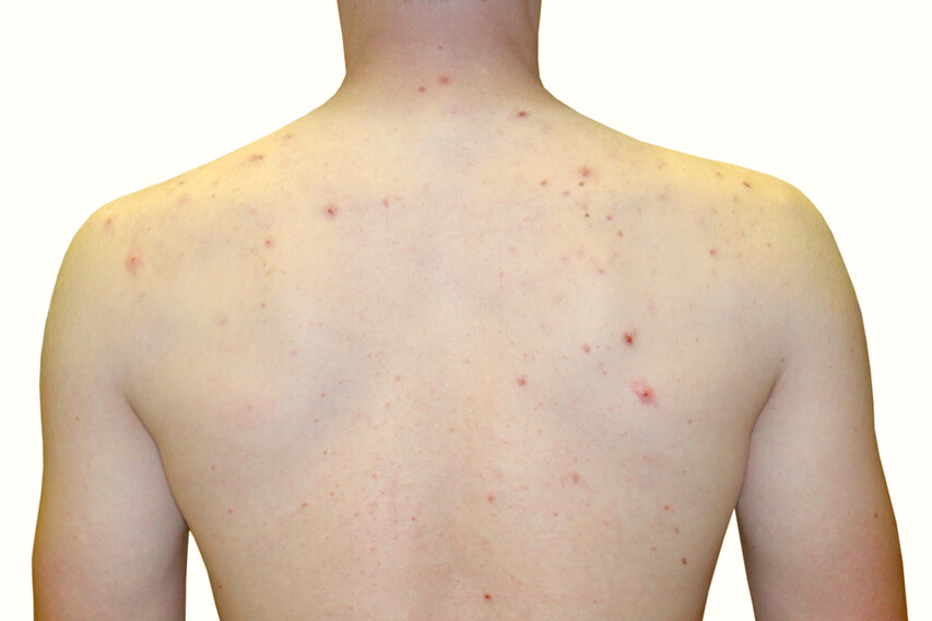 Acne Mechanica Back acne-mechanica-back