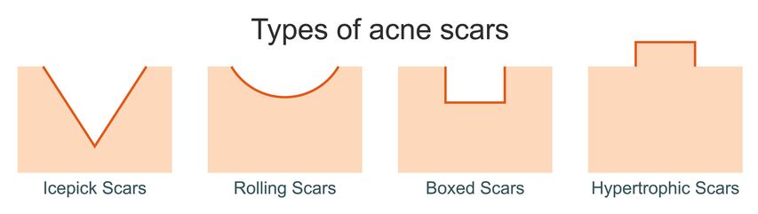 diiferent types of acne scars