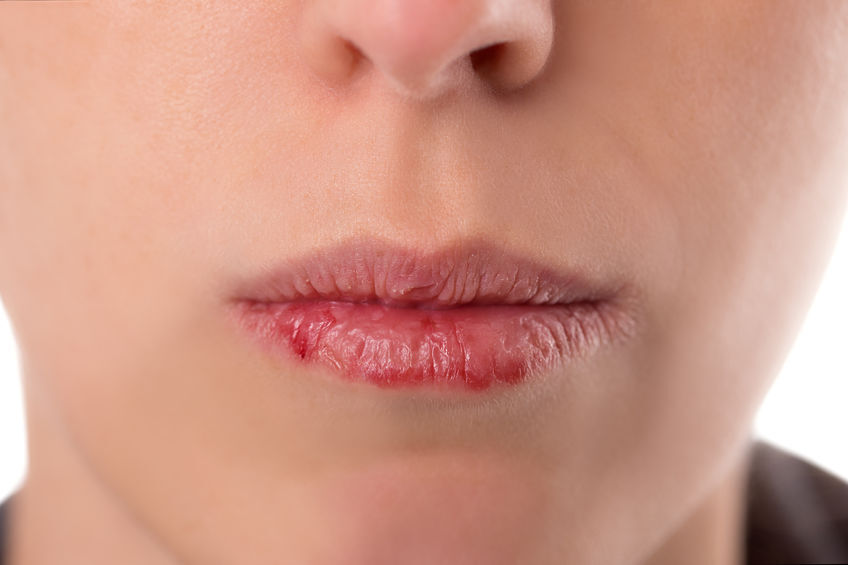 dryness of the lips during acne treatment with accutane