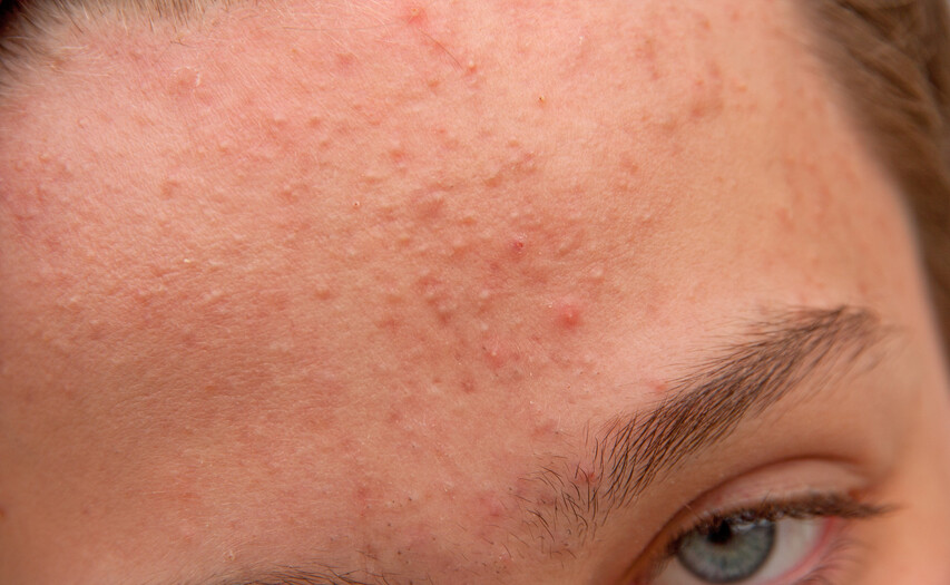 acne on the forehead with many closed comedones and whiteheads