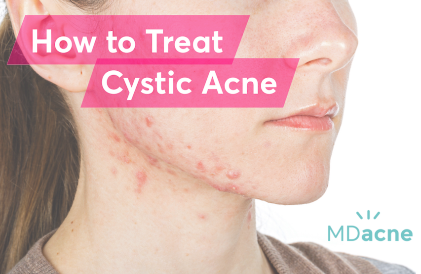 Best cleanser for cystic acne deals