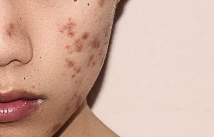 Post-inflammatory hyperpigmentation (i.e. dark spots) from acne 