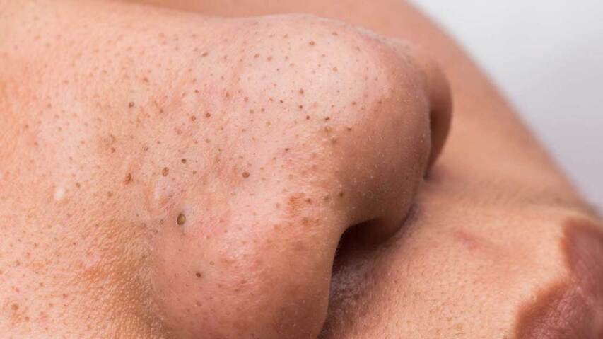 Laser resurfacing to help with acne and blackheads