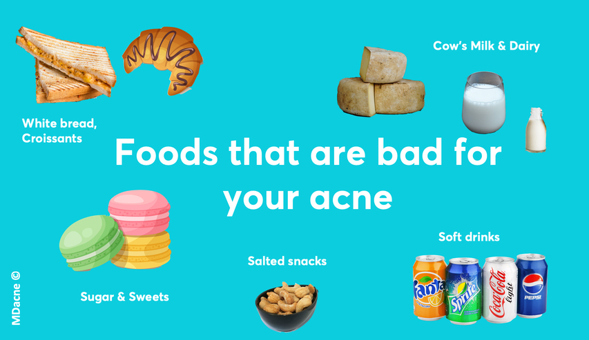 Infographic of foods that are bad for your acne