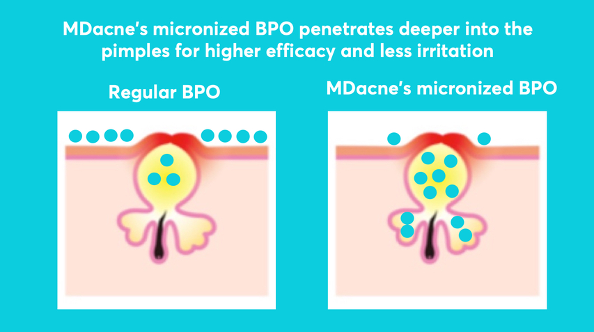 MDacne micronized  benzoyl peroxide