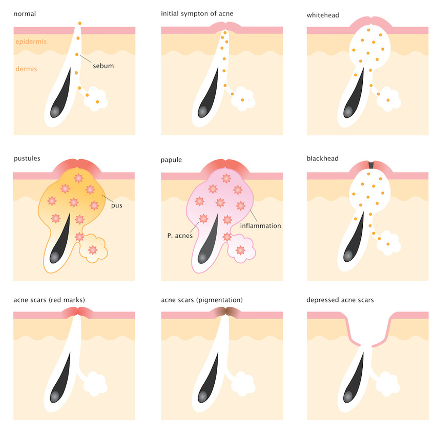 Infographic of different types of acne lesions and scars