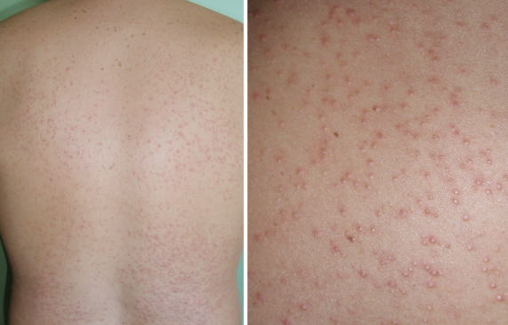 Fungal Acne Causes And Treatments Mdacne Fungal Acne Causes And Treatments Mdacne