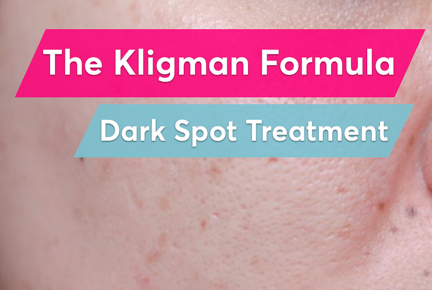 The Kligman Formula is the best prescription treatment for post-acne dark spots 