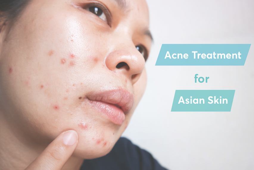 Best acne treatment for Asian skin MDacne