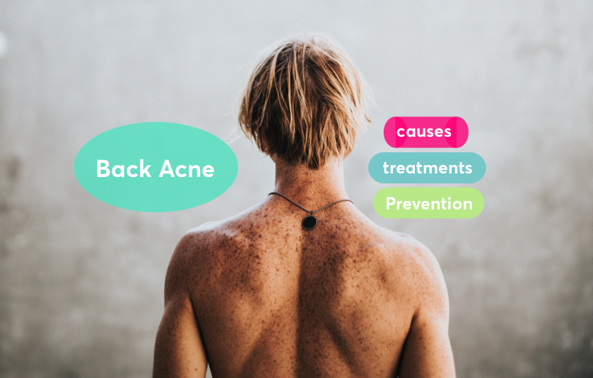 What causes back acne?