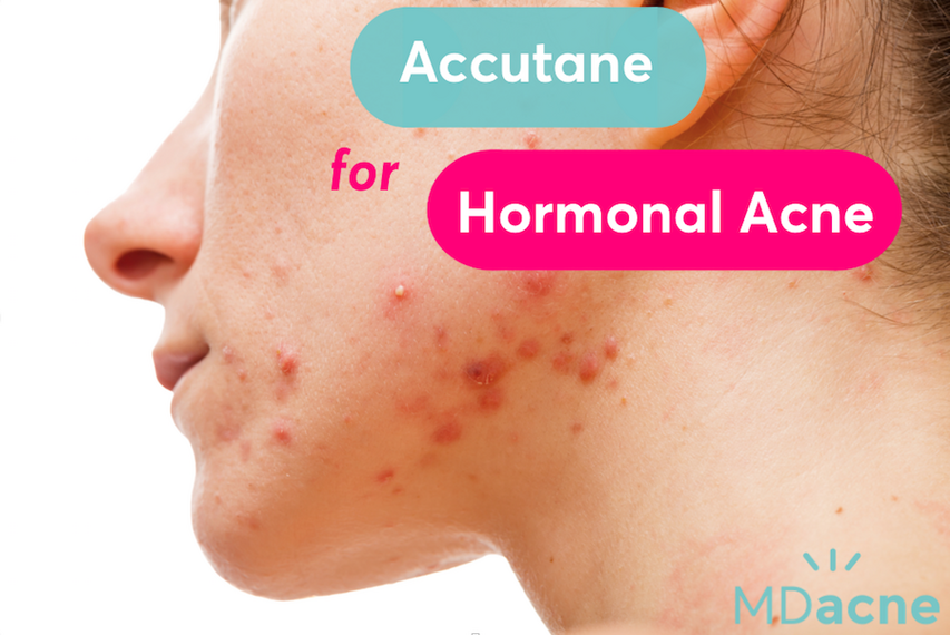 Does Accutane work for hormonal acne?
