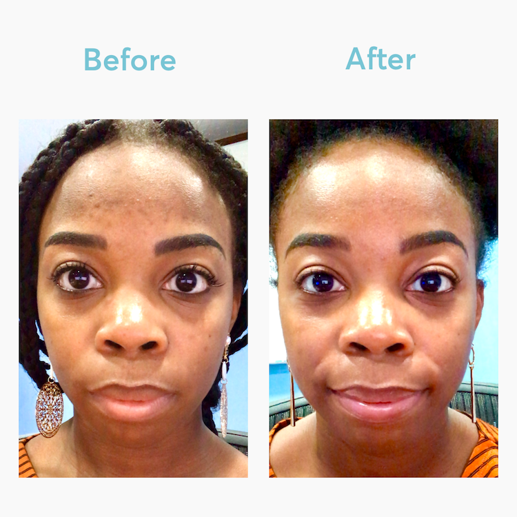 Results from MDacne Medicated Dark Spot Remover