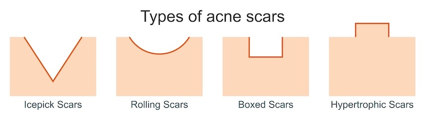 Different types of acne scars