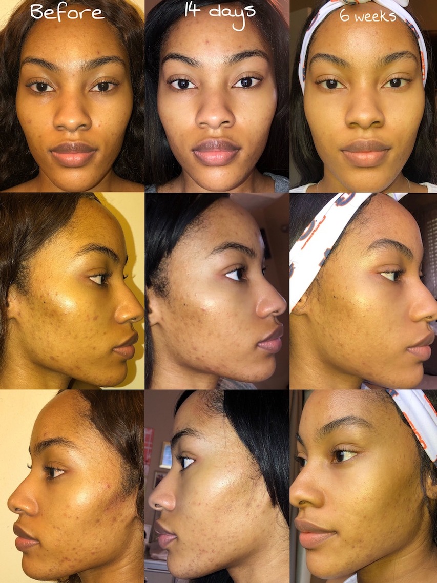 Results from using MDacne's Medicated Dark Spot Remover