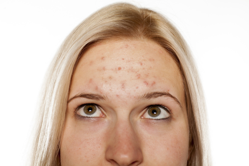 Up close look at woman with acne-prone skin and breakouts