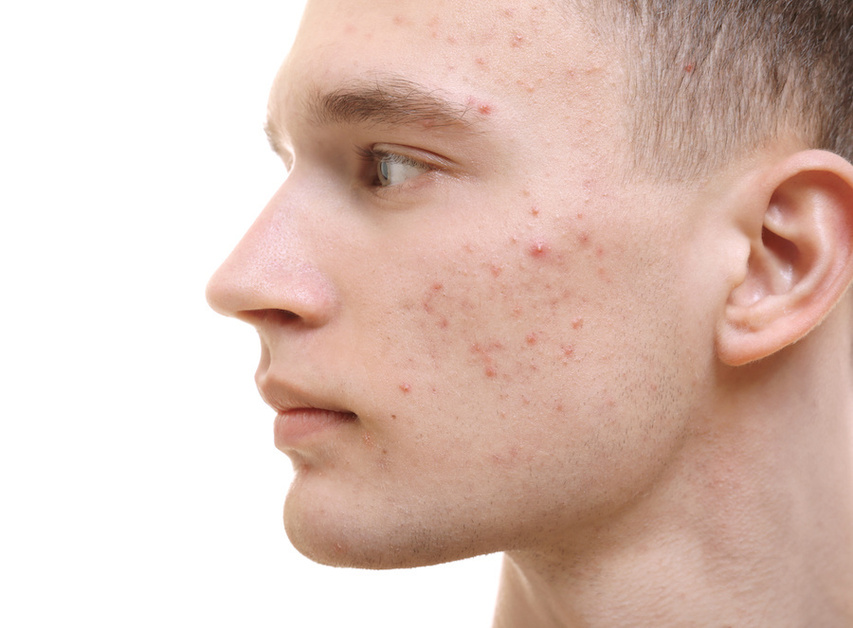 Teenage male expereincing acne purge