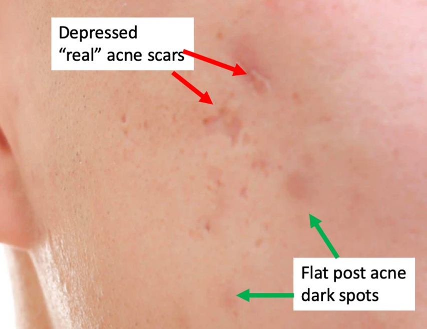 Silicone sheets hot sale for acne scars