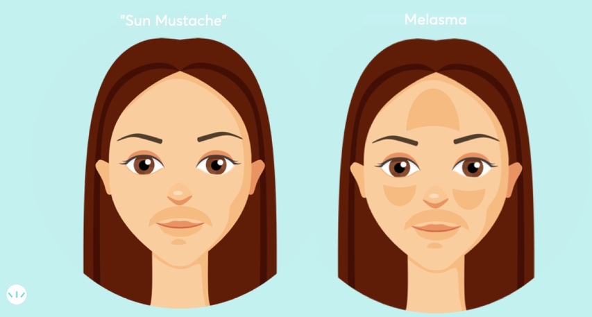 Remove Upper Lip Hair: 4 Ways To Remove Female Mustache - Youtube
