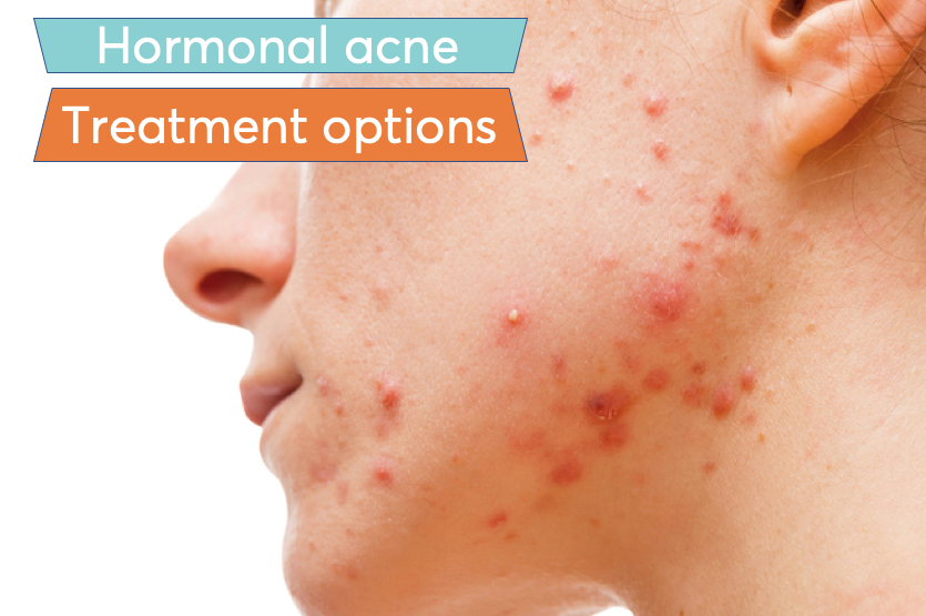 Best birth control pills for women with hormonal acne | MDacne Best birth control pills for women with hormonal acne | MDacne