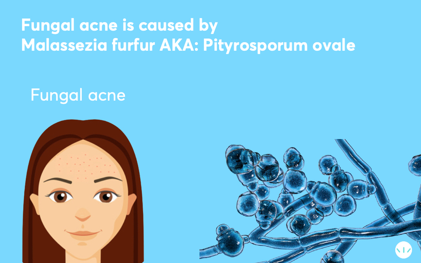 Fungal Acne Causes And Treatments Mdacne Fungal Acne Causes And Treatments Mdacne