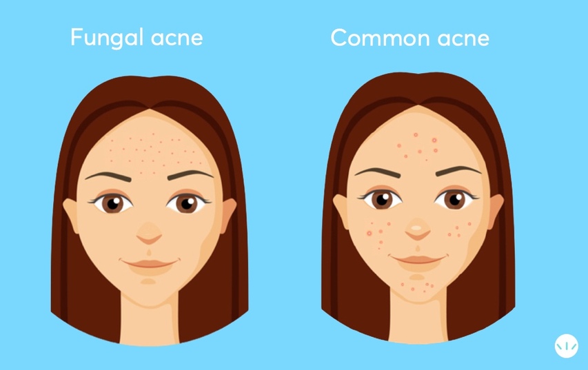 Fungal acne vs common acne 