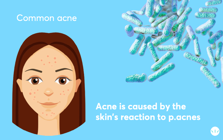 p acnes causes acne