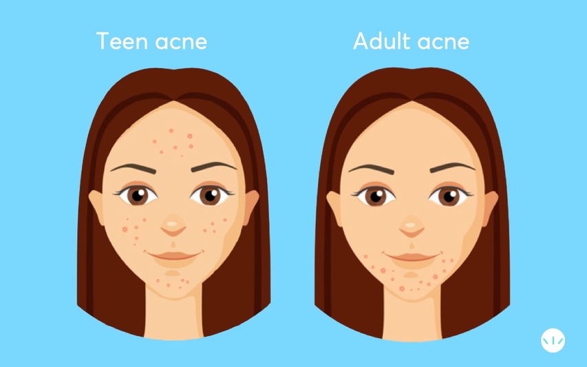 Adult acne vs teen 