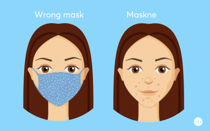 illustration of the location of maskne on the face