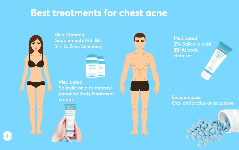 Best treatments for chest acne - affordable and efficient | MDacne