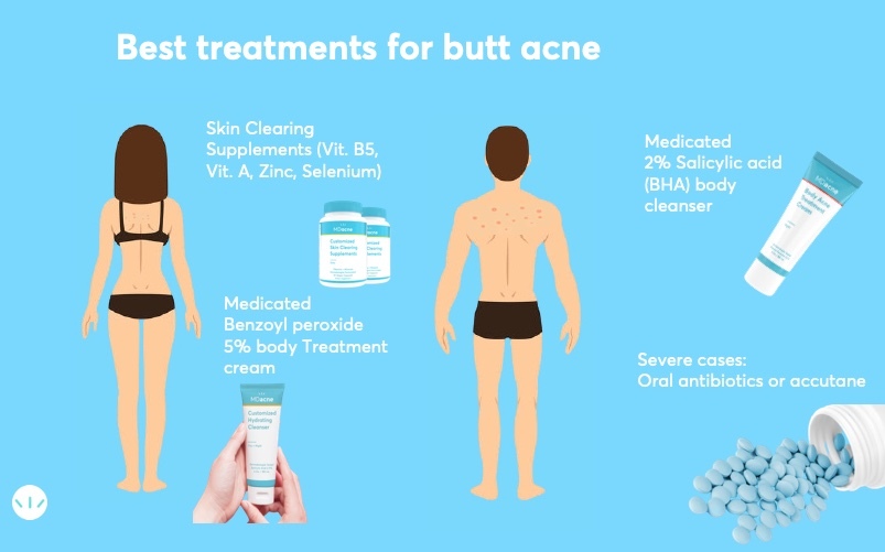 Best treatments for pimples on the buttocks infographics