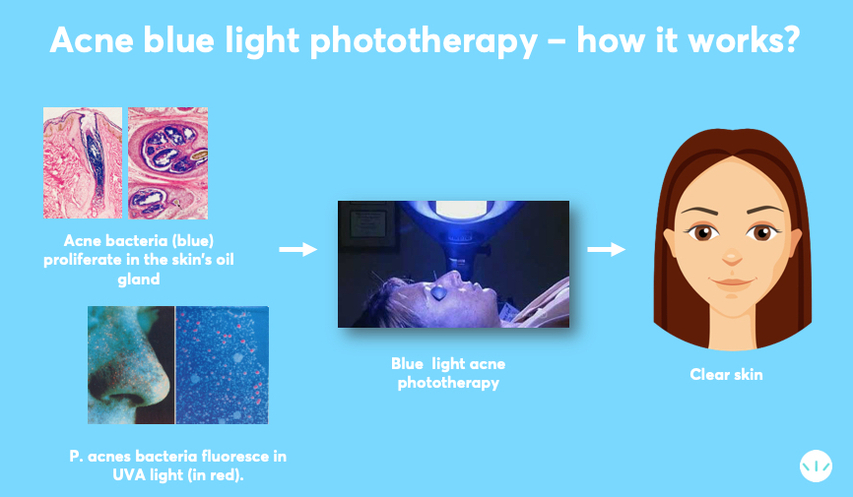 Blue light treatment for acne infographic