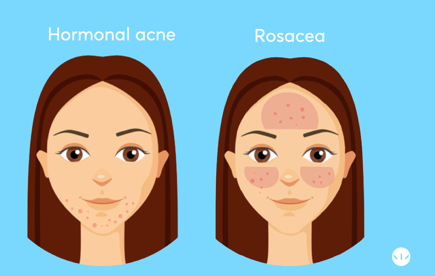 Hormonal acne vs rosacea infographic