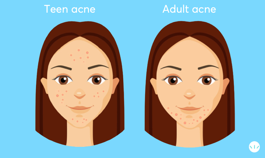 Teen acne vs adult acne infographic