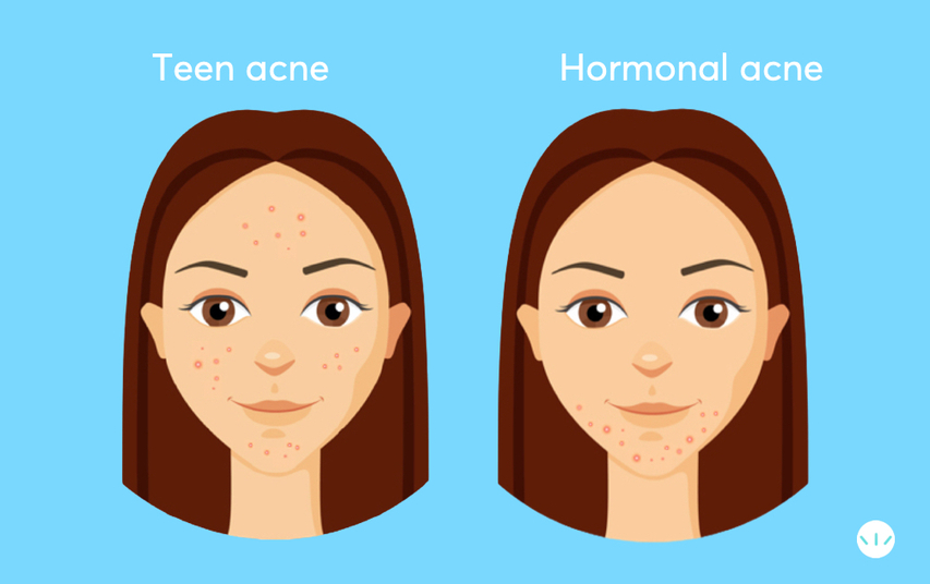 Hormonal acne vs teen acne on the face