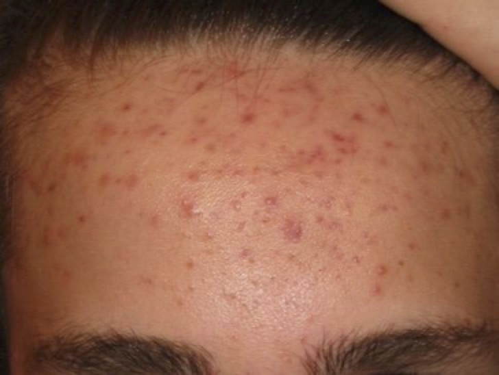 Teen with forehead acne