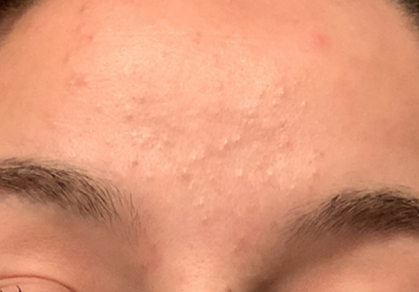 white comedones on a woman forehead