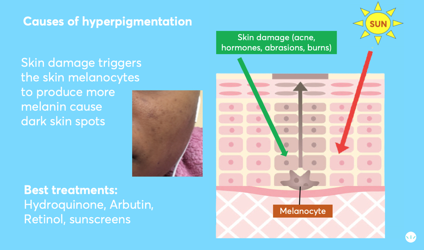 Causes of hyperpigmentation in black skin infographic