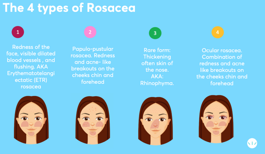 The 4 types of rosacea