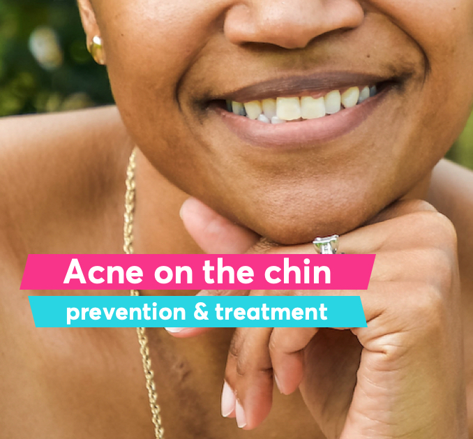 How to Get Rid of Acne on the Chin New Guide | MDacne