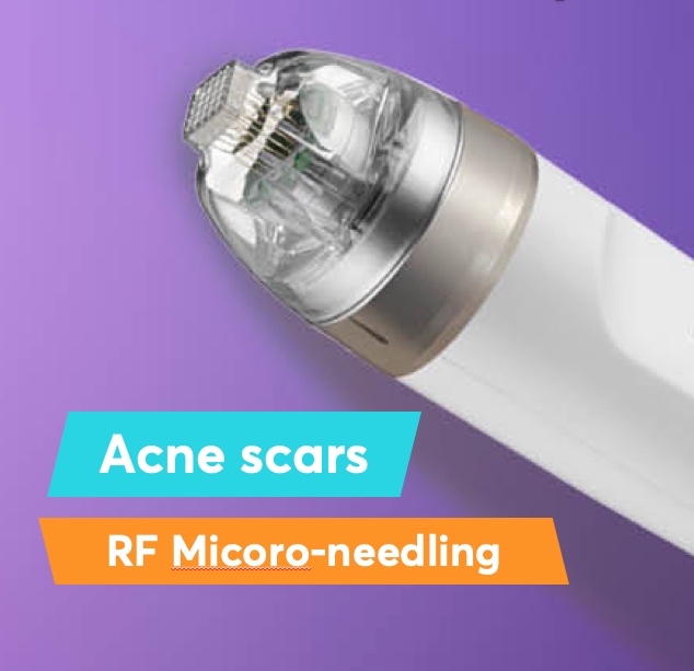 Best office acne scars treatment - micro-needling with radio-frequency ...