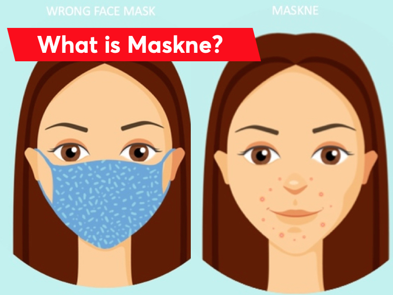 How to prevent maskne according to Dermatologists MDacne